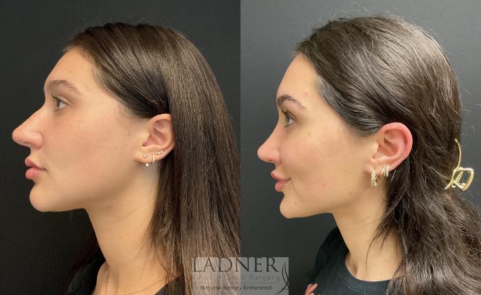 Rhinoplasty before and after results showing improved nasal contour