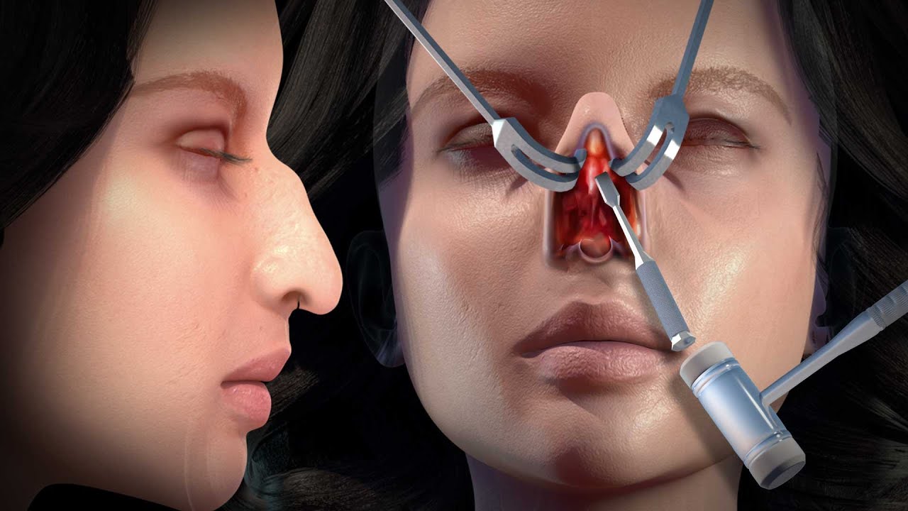 Rhinoplasty surgical procedure step by step